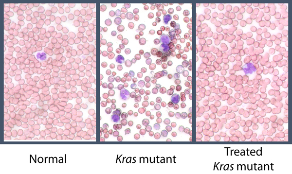 Kras Mutant Blood Cells