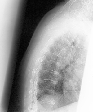 This spine X-ray shows a patient who has osteoporosis.