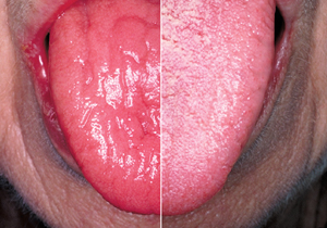 Un'immagine duplex di lingua di un paziente con sindrome di Sjögren