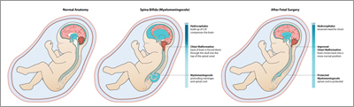 Spina-bifida diagram