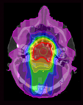 CT scan reveals radiation doses