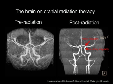 Scans of a brain pre- and post-radiation treatment