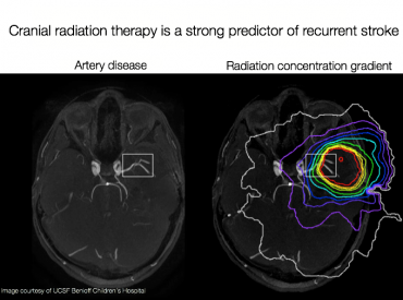 Map of targeted cranial radiation and constricted blood vessels
