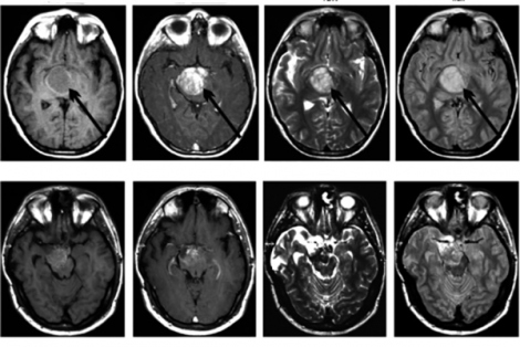 A brain scan of a pediatric patient with diffuse intrinsic pontine glioma