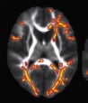Brain image of child with sensory processing disorders, with abnormal areas highlighted in red Brain image of child with sensory processing disorders, with abnormal areas highlighted in red