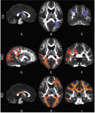 Sensory Processing Disorder (SPD) brain scans
