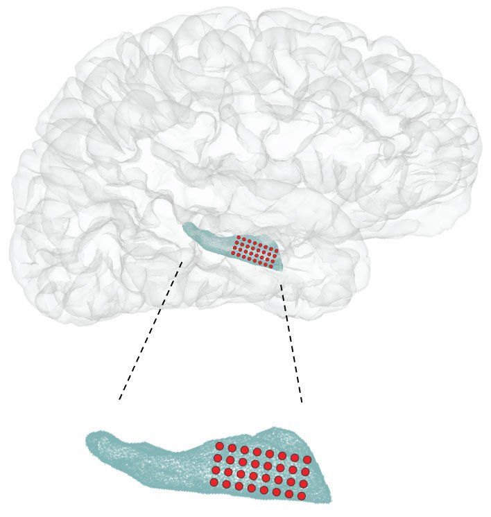 Illustration showing location of hippocampus and electrode during surgery