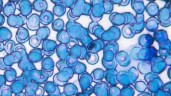 Microscopy of blue and purple cells showing cute lymphoblastic leukemia