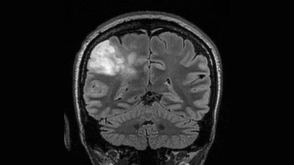 A black and white MRI scan of a brain, with a white highlighted portion on the top left indicating a oligodendroglioma tumor