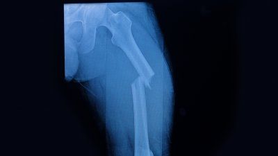 femoral-fracture.jpg