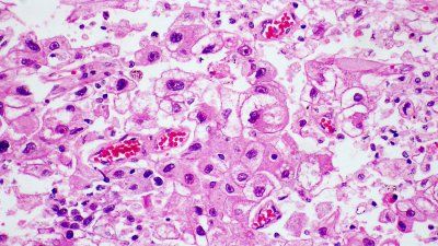 hepatocellular_carcinoma.jpg