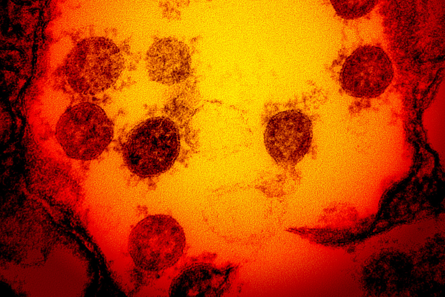 microscopic image of SARS-CoV-2