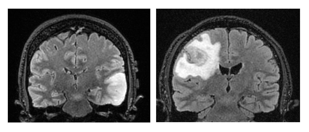 Greyscale MRI imaging of glioblastomas. The left scan shows an early/evolving glioblastoma, and the right scan shows a conventional glioblastoma