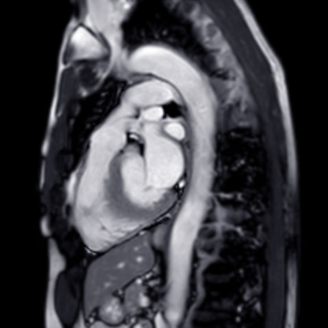 An MRI of a heart