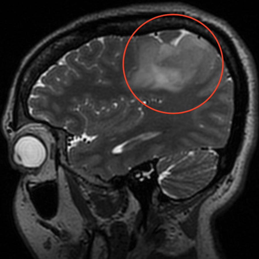 A black and white MRI scan of a brain, with a red circle indicating an oligodendroglioma brain tumor on the top of the brain.