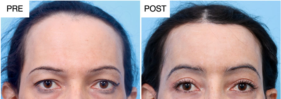 Side by side comparison of a transgender patient before and after getting a hairline and eyebrow lift for facial feminization.