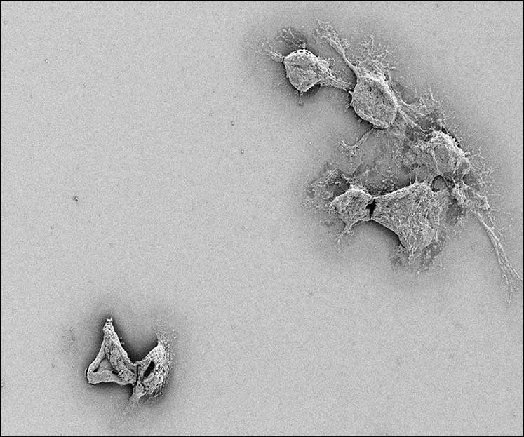 Scanning electron microscopy of reduced tumor microtubes in glioblastoma cells.