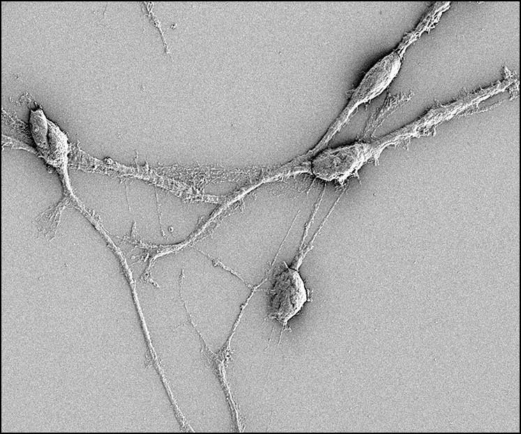 Scanning electron microscopy of tumor microtubes in glioblastoma cells.