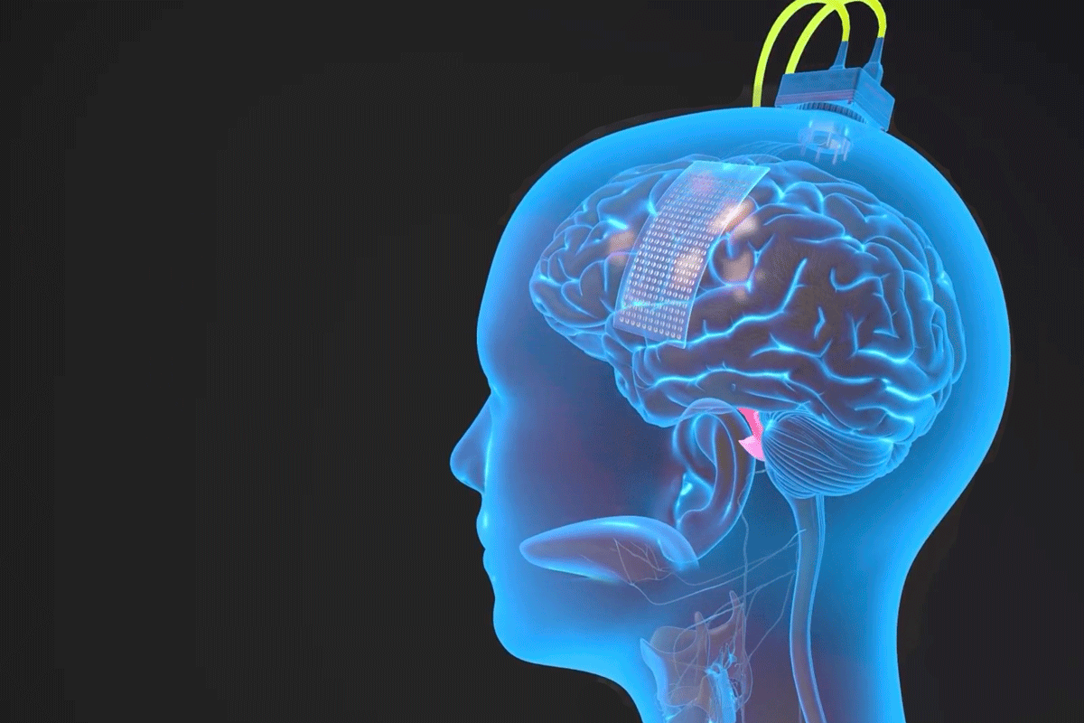 A graphic animation of a head, showing the brain, tongue, and vocal muscles within it. A thin implant rests on the left surface of the brain, and a wire connects the implant to lead to an external vocal device.