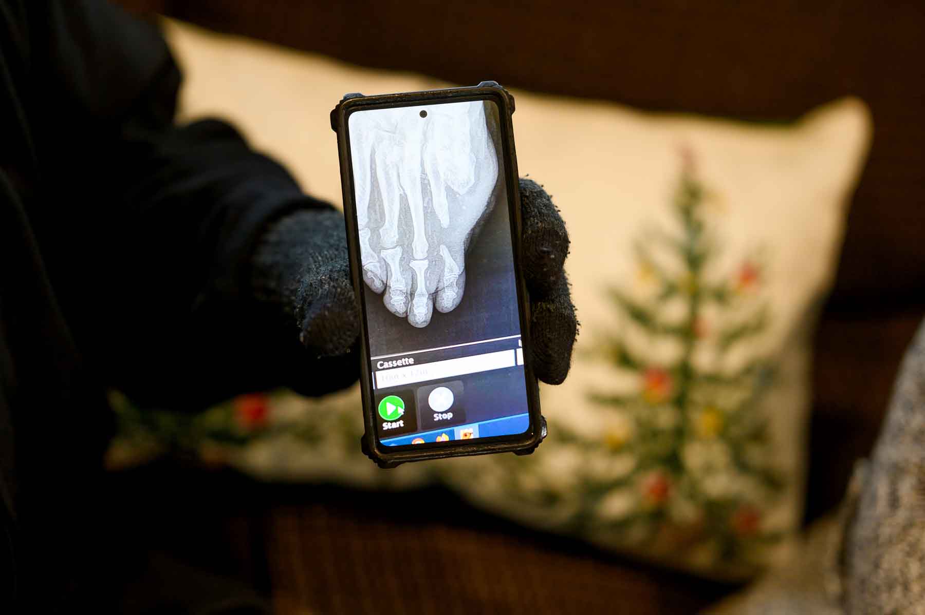 A man displays a photo of an x-ray of his right foot, which has undergone an amputation of the big toe.