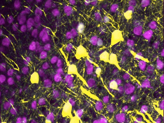 A microscopic image showing brain neurons and their elongated conenctions to one another. This image shows few connections between the neurons, which have been destroyed by inflamation.
