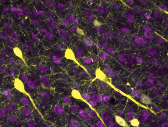 A microscopic image showing brain neurons and their elongated conenctions to one another. This image shows very few connections between the neurons, which have been severely destroyed by inflamation.