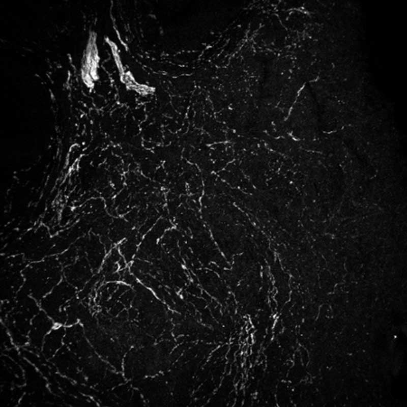 A microscopic image showing a larger presence of dense sympathetic nerve cells in an ovary at age 55.