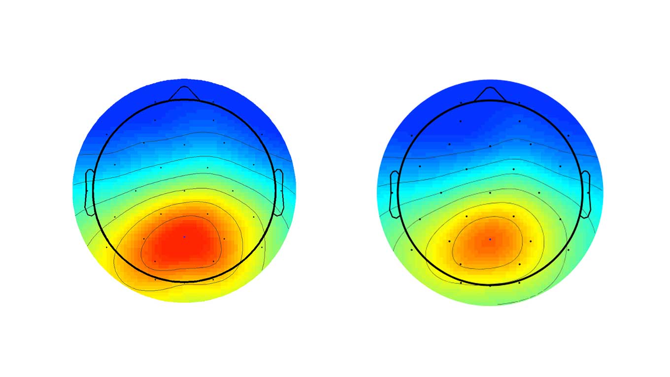 An electroencephalogram (E E G) scan of two scalps pointing to brains that are more or less susceptible to develop schizophrenia.