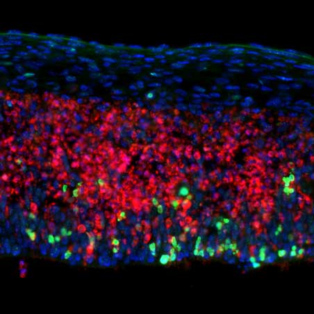 Microscopic image of neurons without DNA repair against a black background, showing damage and dying cells in green and red.
