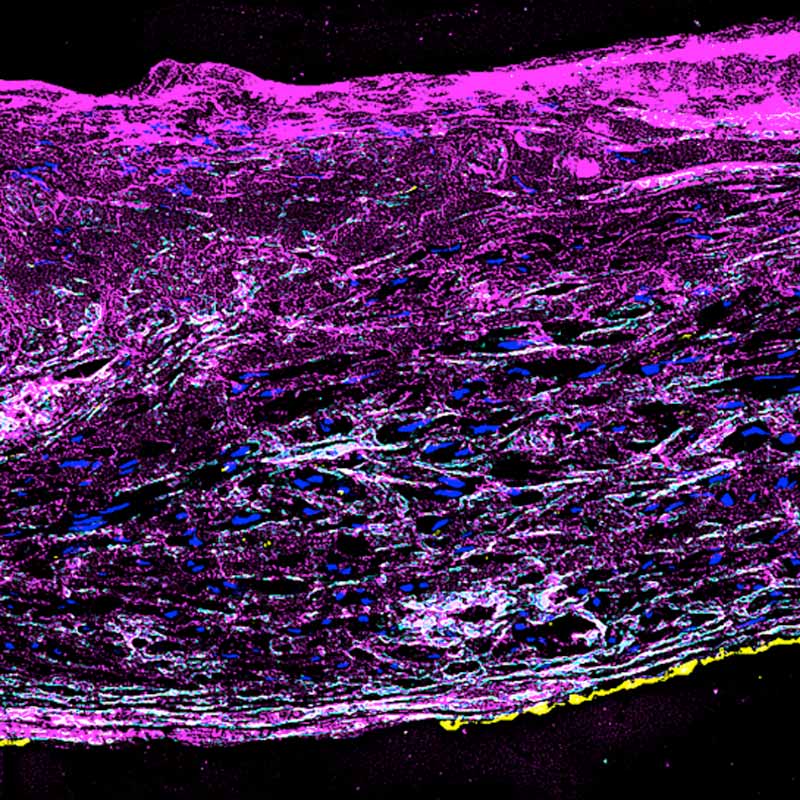 Scientific microscope image of aneurysm tissue. Bright magenta layers form an uneven, disorganized vessel wall containing many blue cells and a thin yellow edge against a black background.