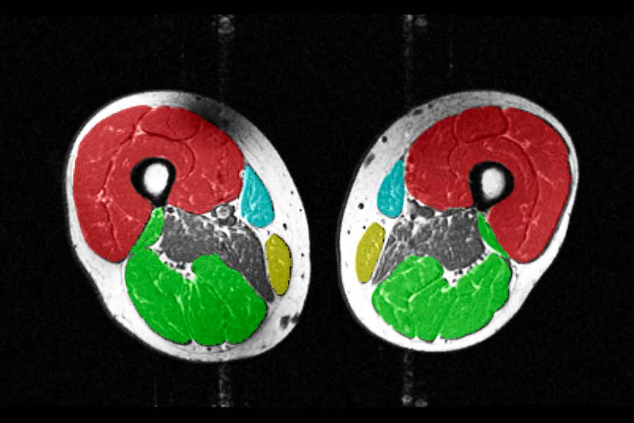 MRI images of thigh muscles in a 62-year-old participant in the study, including quadriceps (red), hamstrings (green), sartorius (turquoise) and gracilis (yellow) showing more muscle volume before a weight cycle.
