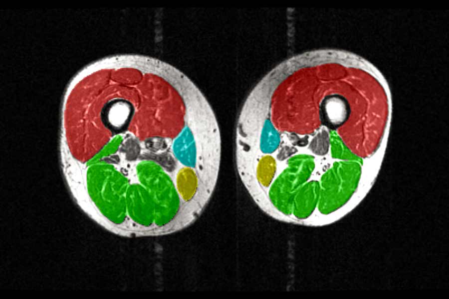 MRI image of the thighs with color-coded muscle groups, showing less muscle volume.