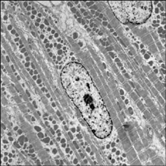 Microscopy image of heart muscle showing numerous macrophages as dark spots between muscle fibers.