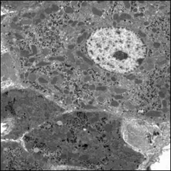 Microscopy image of liver tissue showing abundant macrophages as dark spots among the cells.