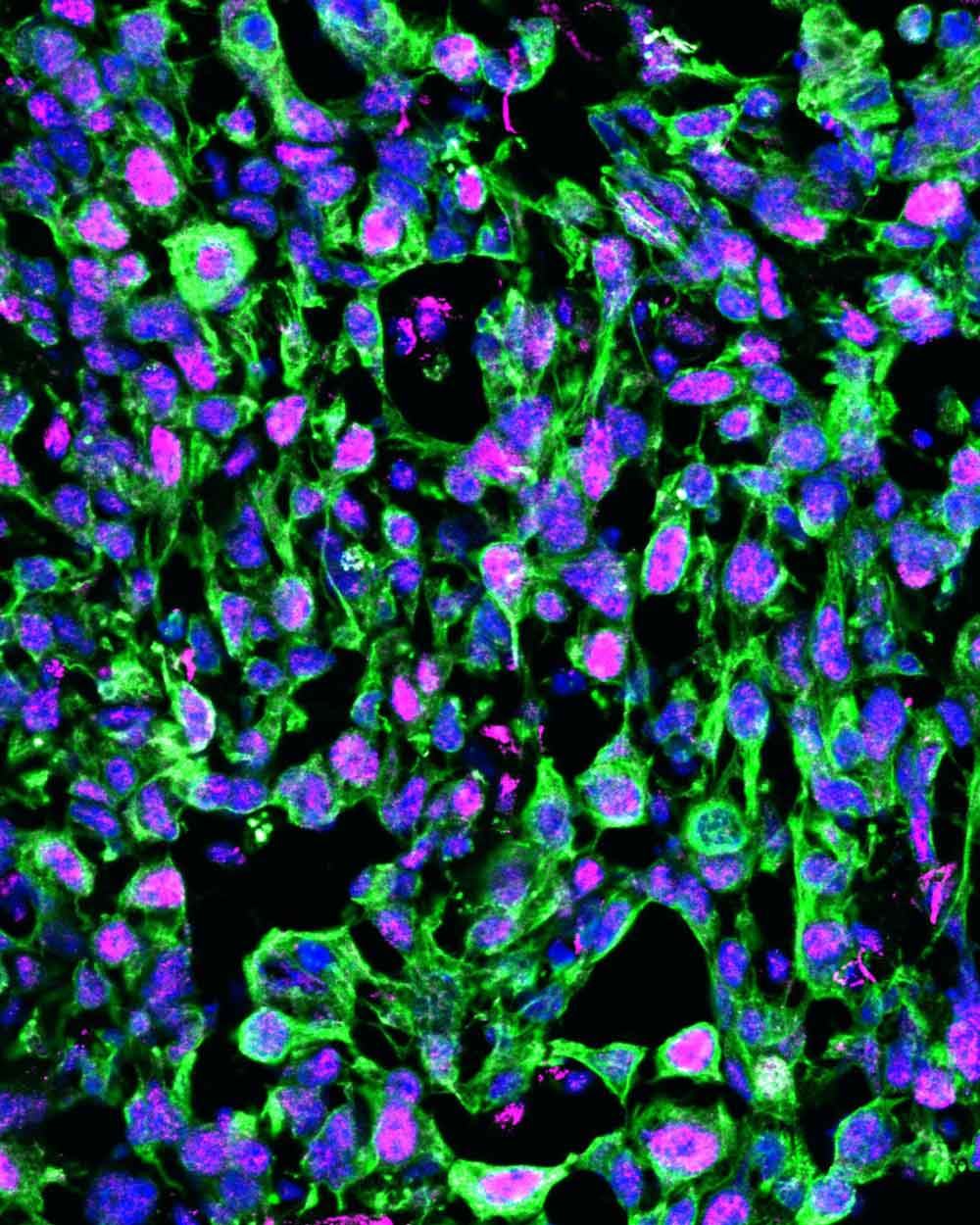 Fluorescent microscopy image of a stiff mammary tumor showing widespread pSTAT3 signaling highlighted in pink among green and blue cells.
