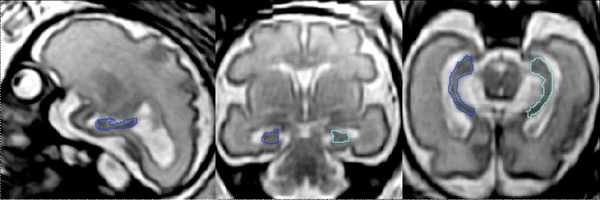 Three views of the right (blue) and left (green) hippocampus of a healthy develo