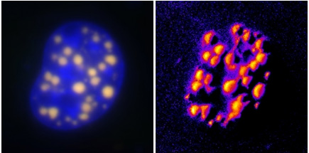 On the left is a conventional fluorescent microscopy image highlighting aggregations of the protein that is abnormal in Huntington's disease (HD). On the right, the new FRET method.