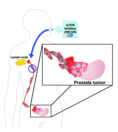 A group of proteins that lead to prostate cancer metastasis and can be targeted 