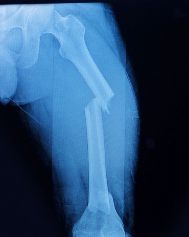 X-ray image of a broken femur bone