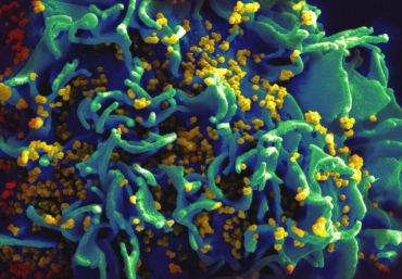 a scanning electromicrograph shows an HIV-infected H9 T-cell