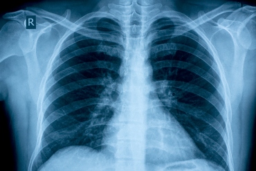 a chest x-ray
