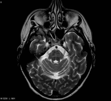 MRI of patient with Multiple System Atrophy.