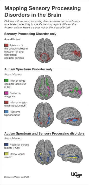 Children with sensory processing disorders have decreased structural brain connectivity in specific sensory regions different than those in autism.