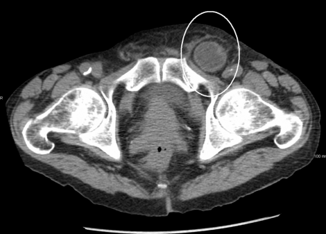 An incarcerated inguinal hernia on a cross sectional CT scan