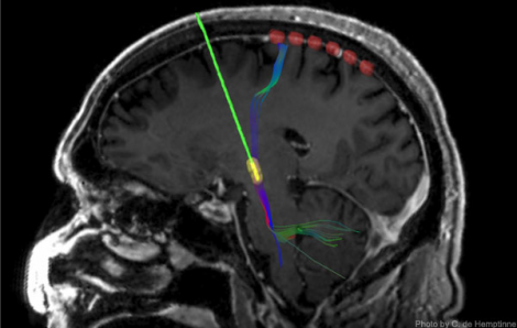 In the new research, during surgery to implant a permanent DBS device (green with yellow tip) deep in the brains of Parkinson's disease patients, six recording electrodes (red) were temporarily placed on the surface of the brain.