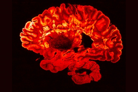 An MRI scan of a person with multiple sclerosis shows bright spots, which are MS plaques