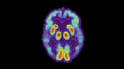 a brain scan shows colored areas of the brain in an Alzheimer's patient