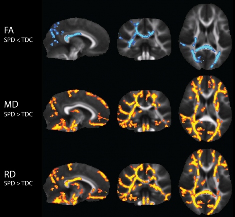 The first row (in blue) shows areas of the brain where children with SPD have less white matter than typically developing children. This is especially evident in the back of the brain, the primary site for transmitting sensory information. Rows two and three (in orange) show parts of the brain where children with SPD have more white matter – although the “structural integrity” is impaired.