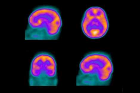 blood flow to the brain is shown from several angles in a SPECT scan