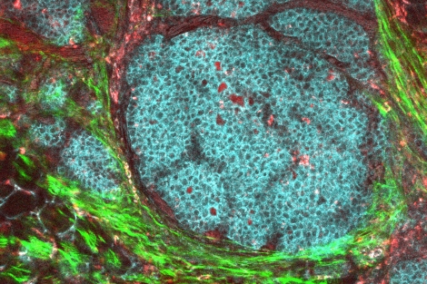 a breast cancer tumor and its surrounding tissue